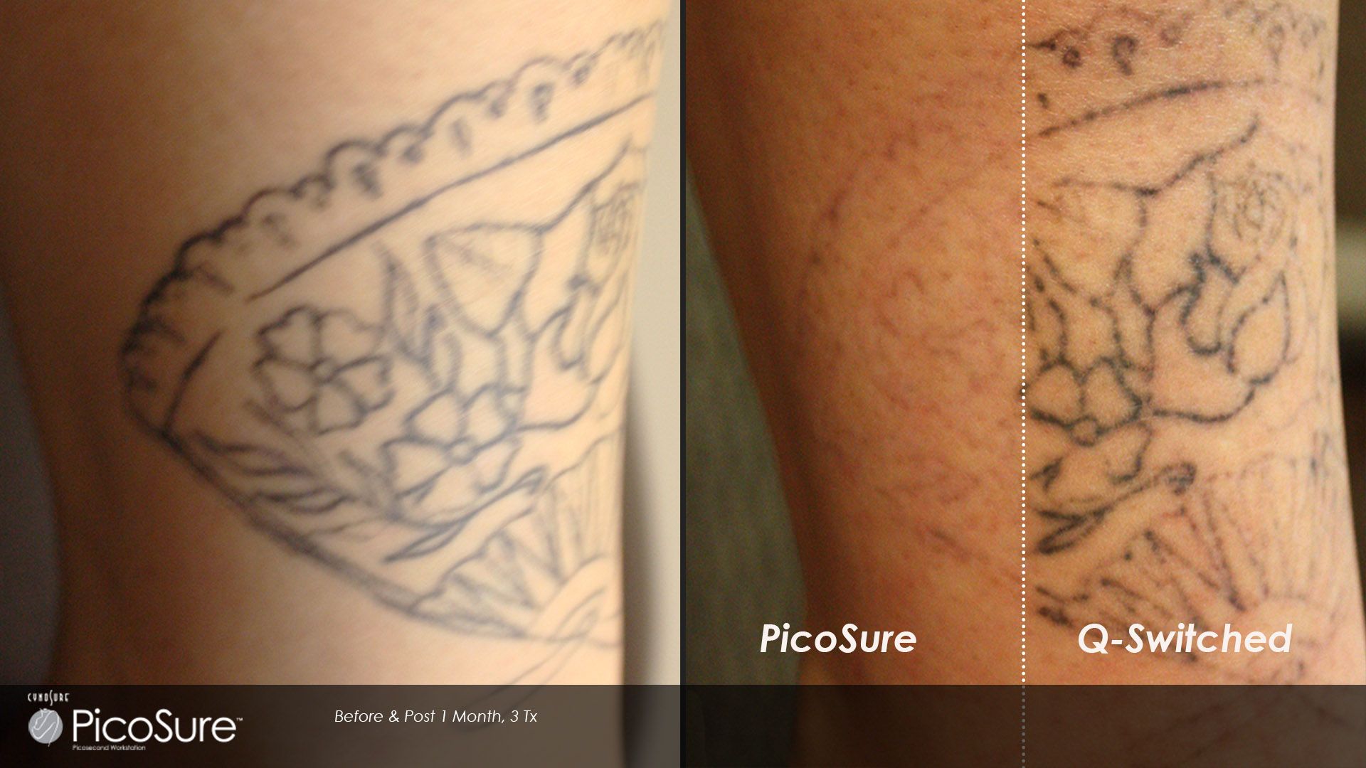 Before and after laser tattoo removal results