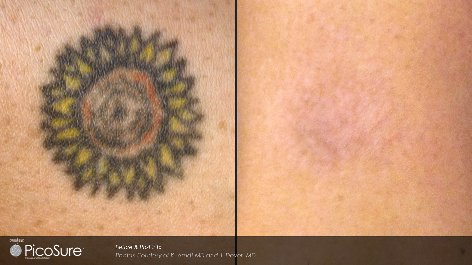 Before and after laser tattoo removal results