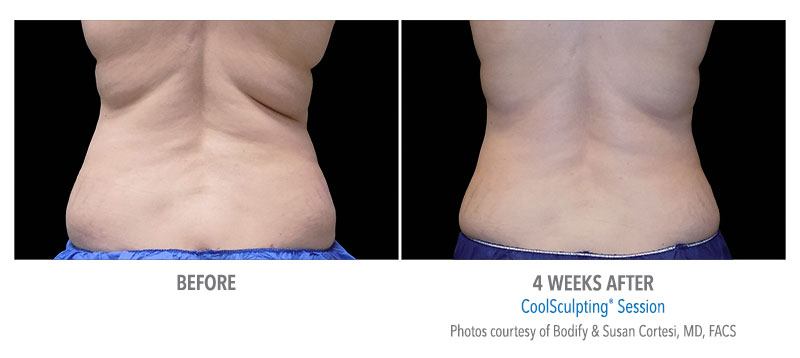 Before and after CoolSculpting® results