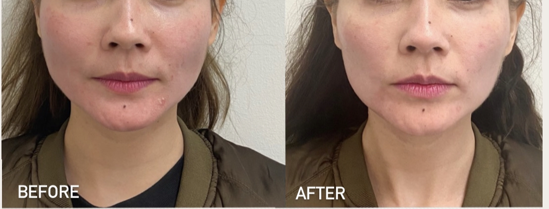 Before and after Botox and Forma results