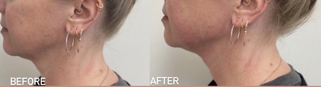 Before and after jawline filler results