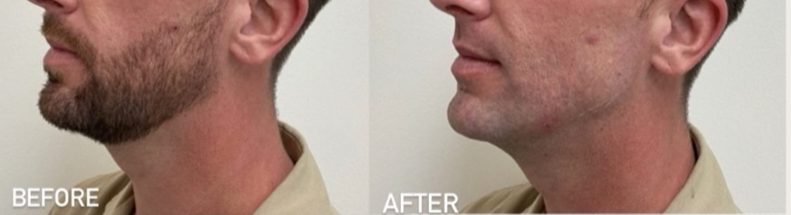 Before and after jawline filler results