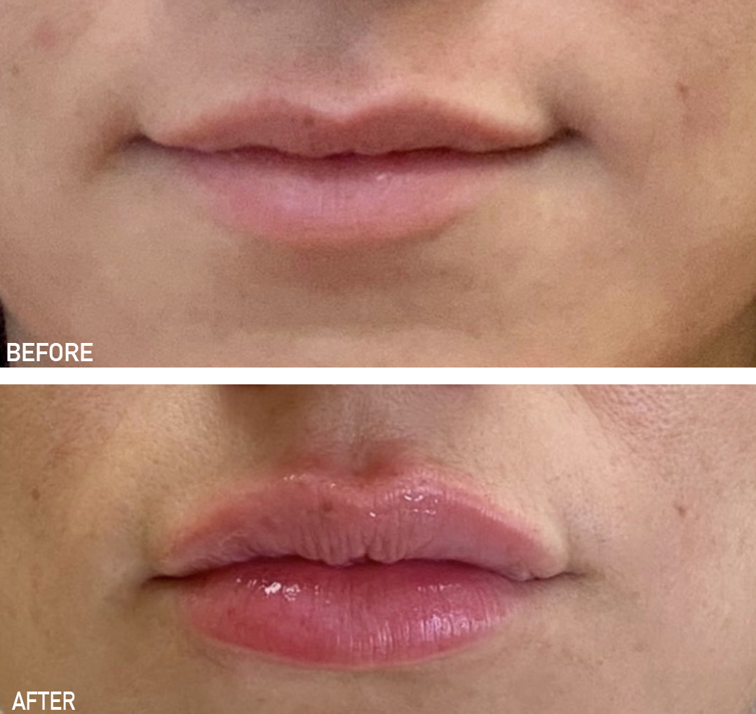 Before and after lip filler results