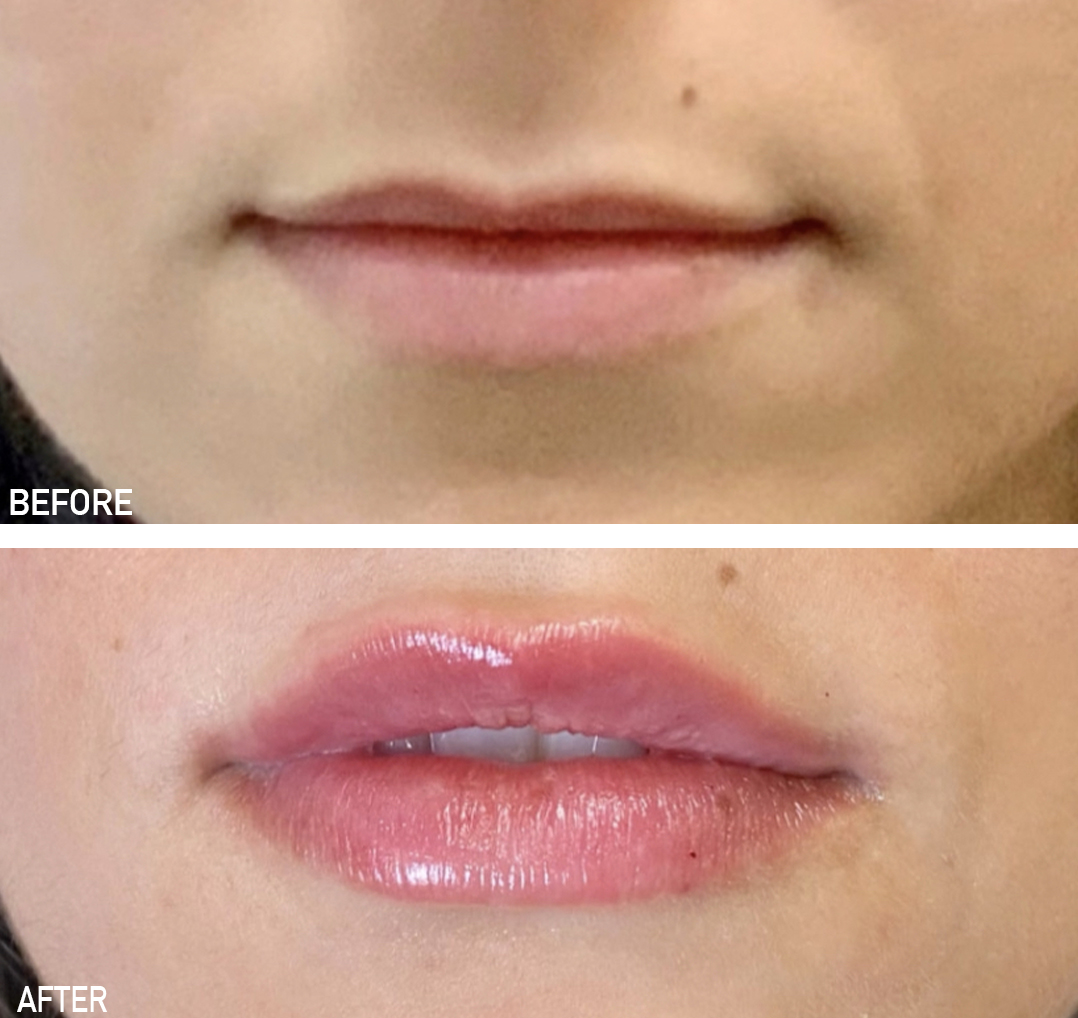Before and after lip filler results