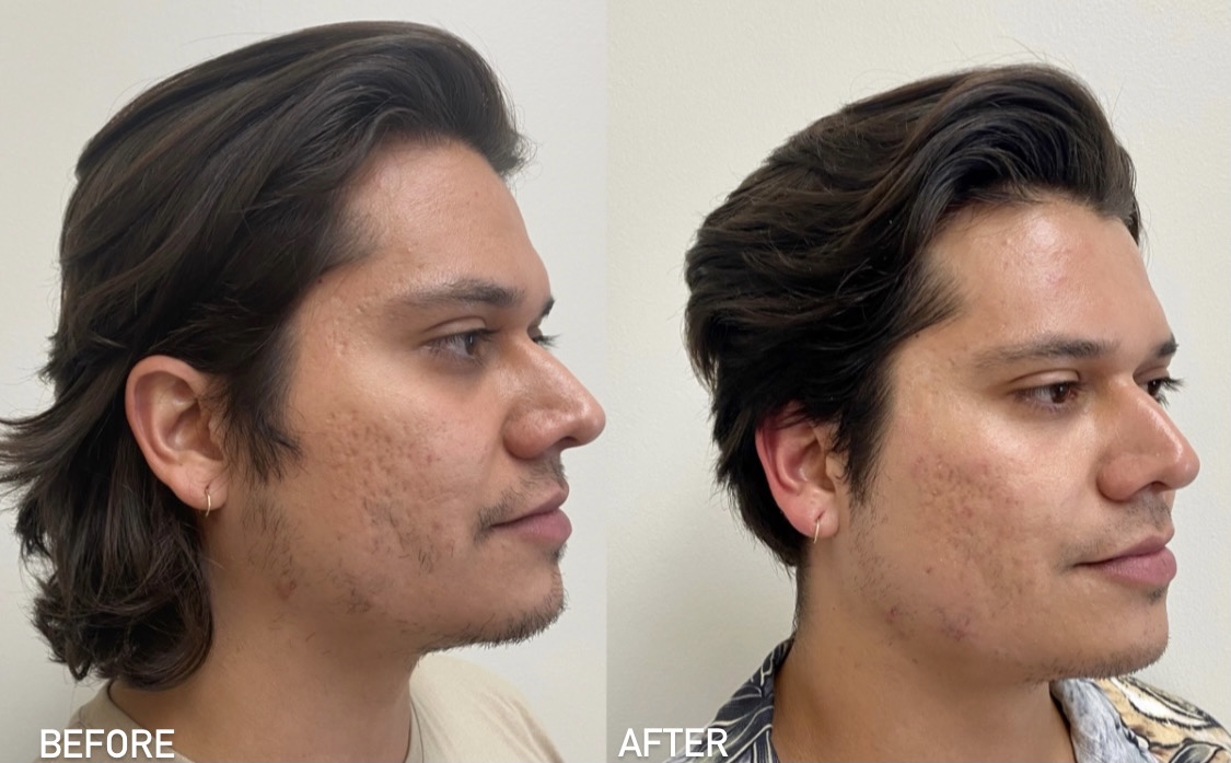 Before and after Morpheus8 & PRP treatments