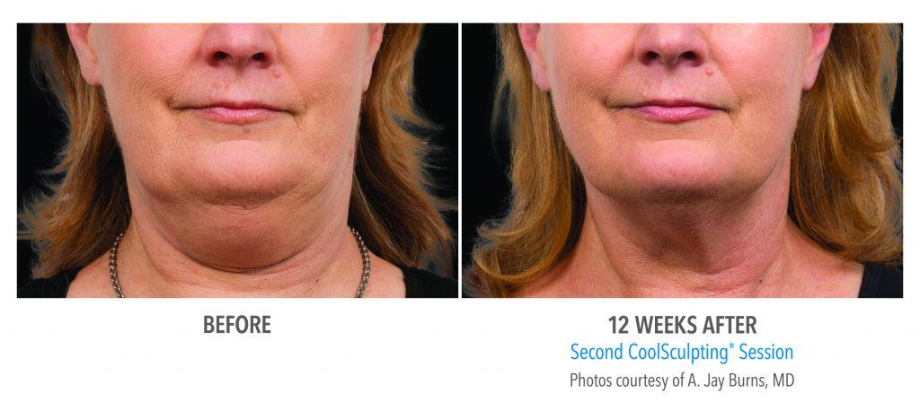 Before and after CoolSculpting® results