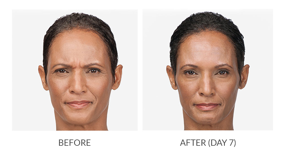 Before and after BOTOX® results