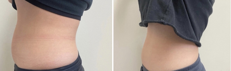 Before and after Coolsculpting stomach results