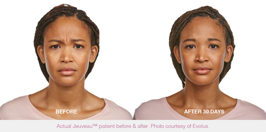 Before and after Jeuveau® results