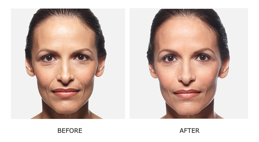 Before and after JUVÉDERM® results