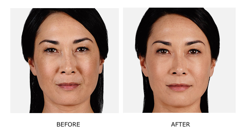 Before and after JUVÉDERM® results