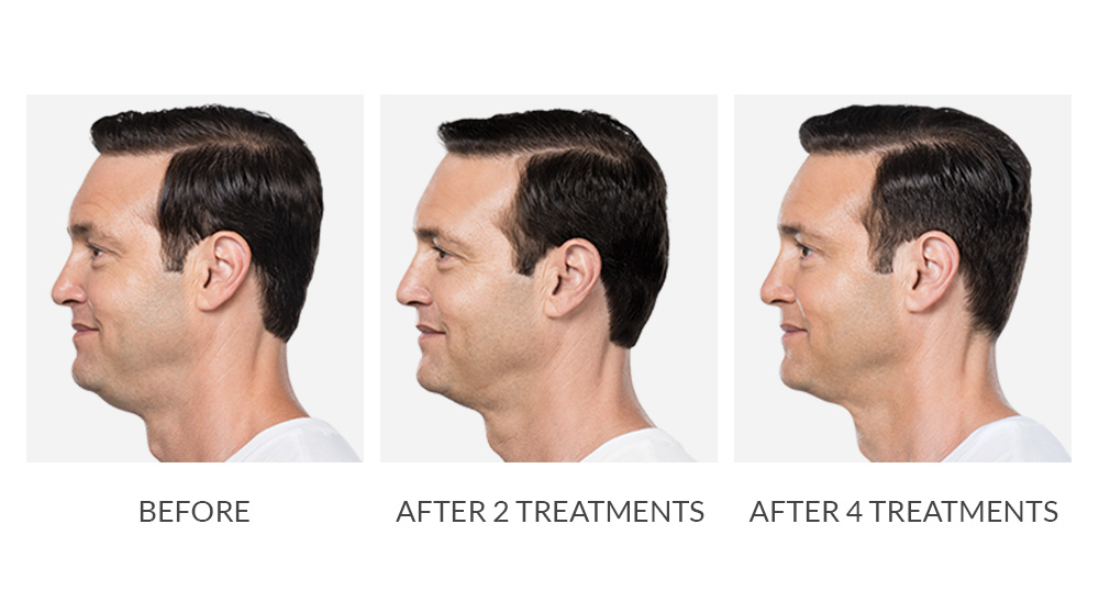Before and after KYBELLA® results
