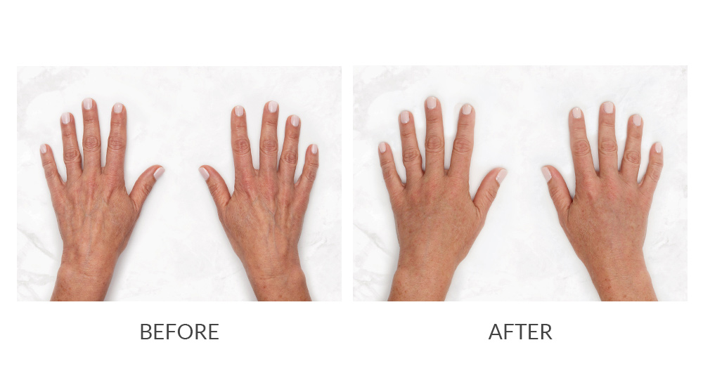 Before and after Restylane® hand results