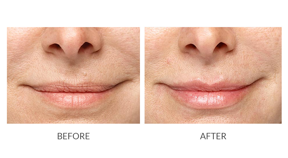 Before and after Restylane® results